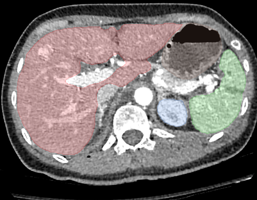 ansys-abdominal-injury-model Diagram