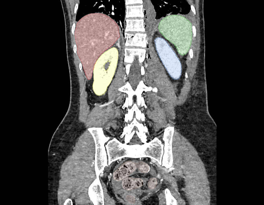 ansys-abdominal-injury-model Diagram