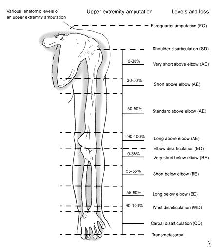 ansys-prosthetic-limb-analysis Diagram
