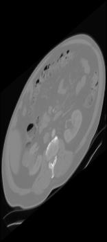 comsol-artificial-kidney-model Diagram