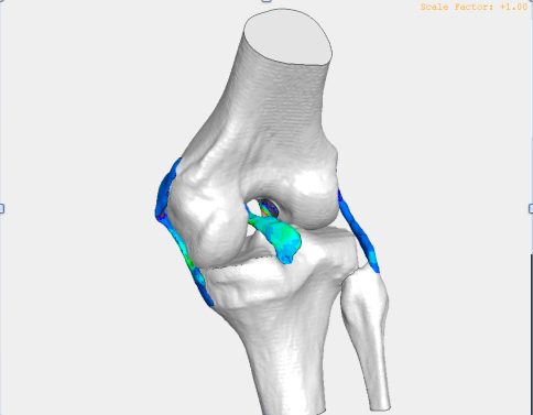 Maximum principal stresses in the ligaments of the knee — FEA result