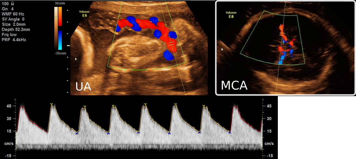 esophageal-doppler Diagram