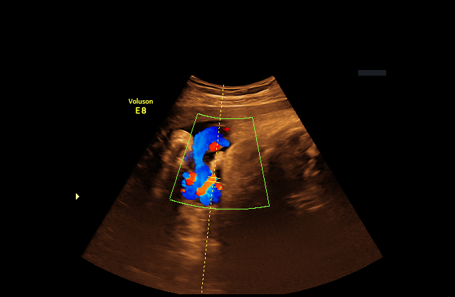 esophageal-doppler Diagram