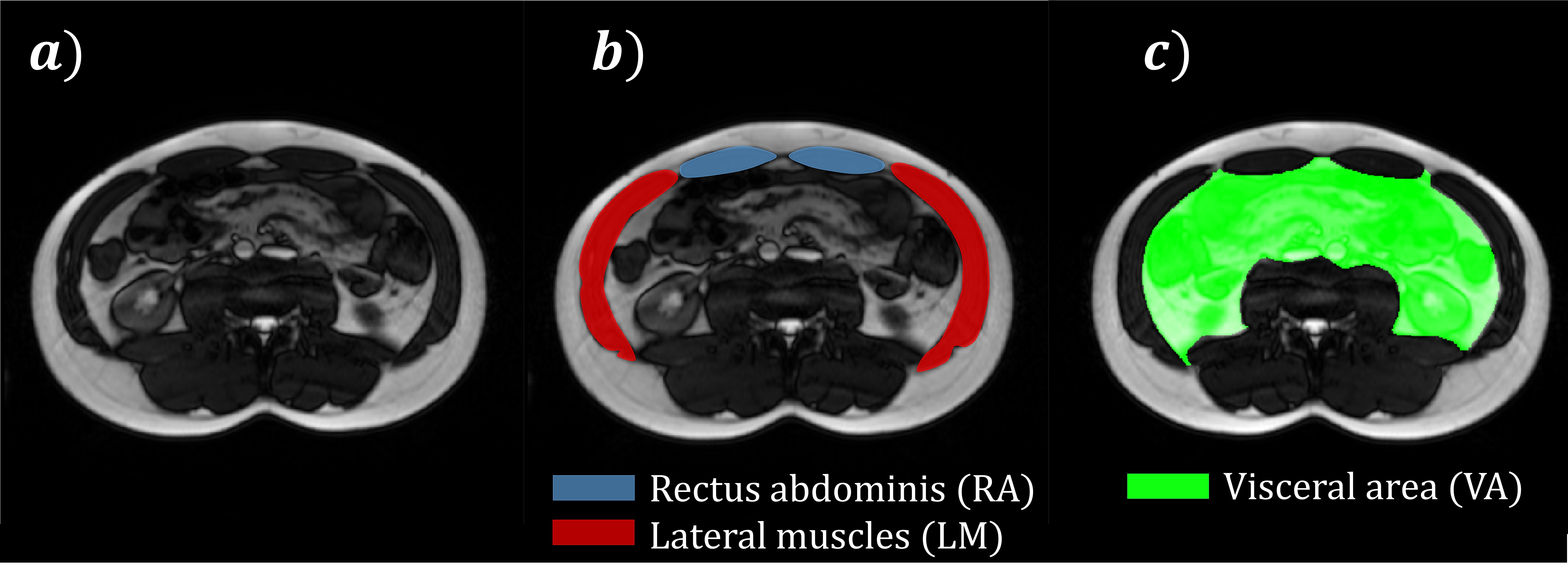 intra-abdominal-pressure Diagram