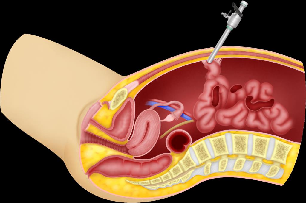 simscale-surgical-tool-stress Diagram