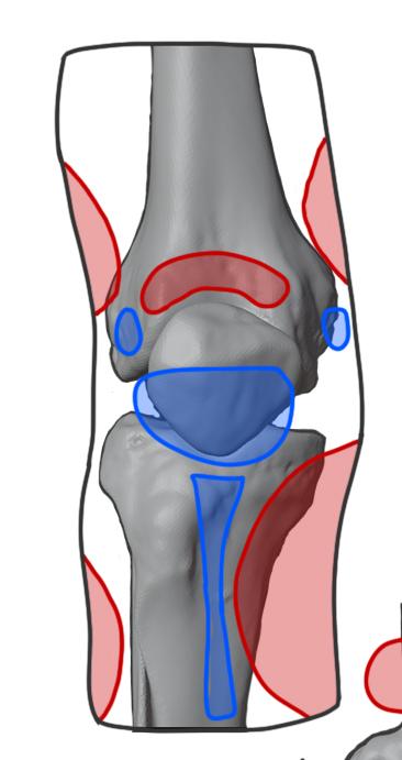 simulia-abaqus-prosthetic-socket Diagram