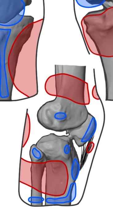 simulia-abaqus-prosthetic-socket Diagram