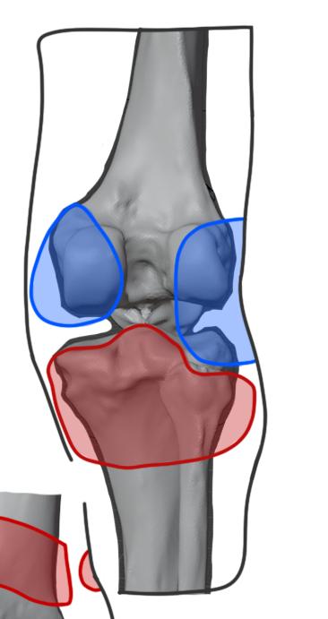 simulia-abaqus-prosthetic-socket Diagram