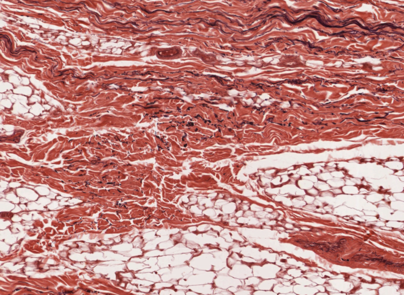 simulia-living-heart-pathology Diagram