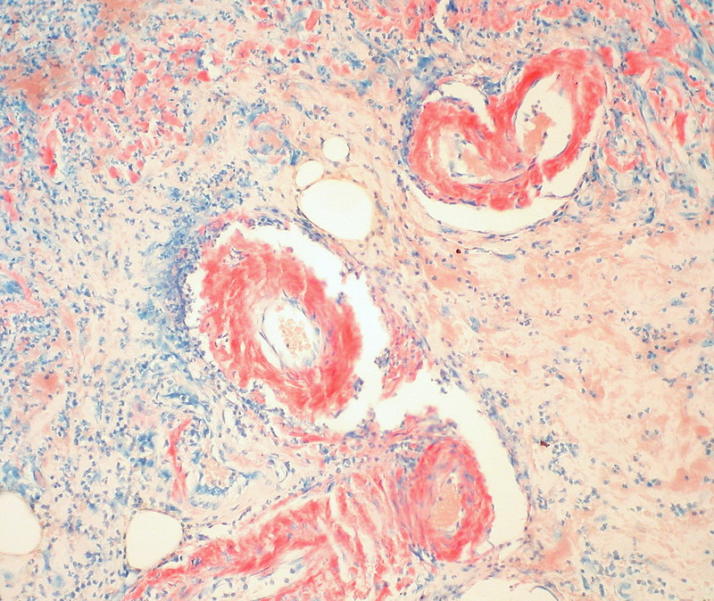 simulia-living-heart-pathology Diagram