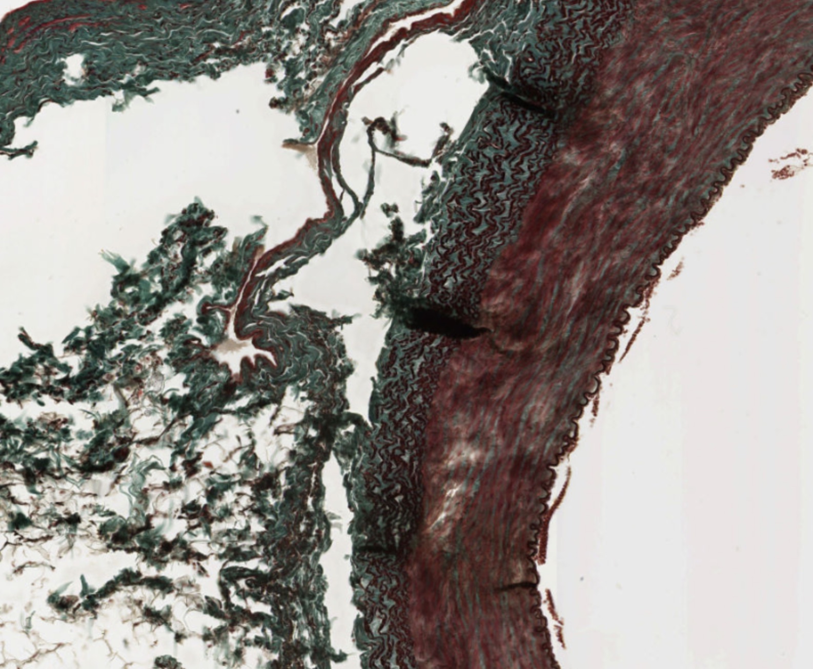 simulia-living-heart-pathology Diagram