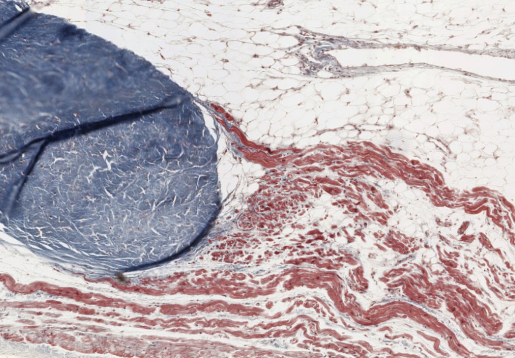 simulia-living-heart-pathology Diagram