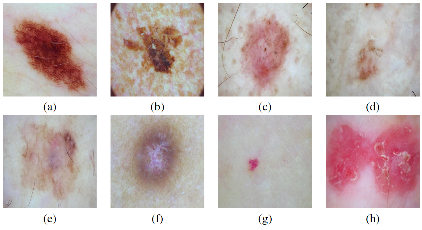 skin cancer classification cnn capstone project Diagram