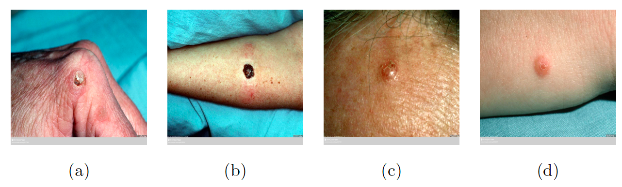 skin cancer classification cnn capstone project Diagram