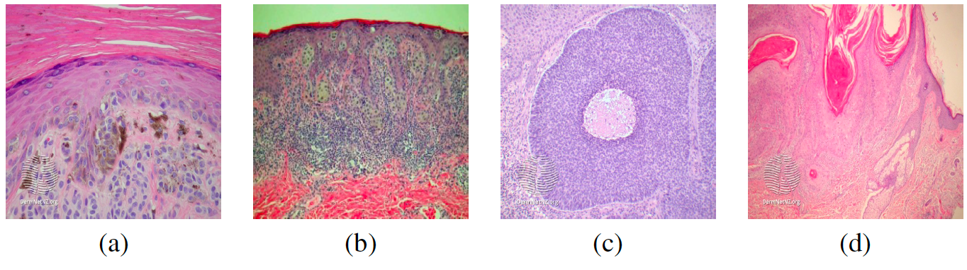 skin cancer classification cnn capstone project Diagram